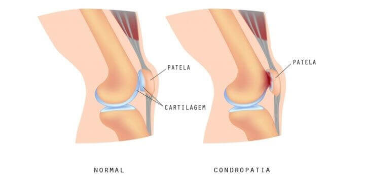 Condromalácia Patelar 20