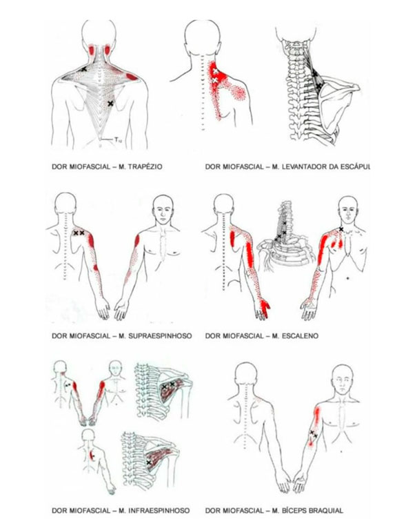 Pontos de dores, veja como a dor no ombro se apresenta 
