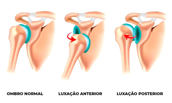 Luxação do ombro