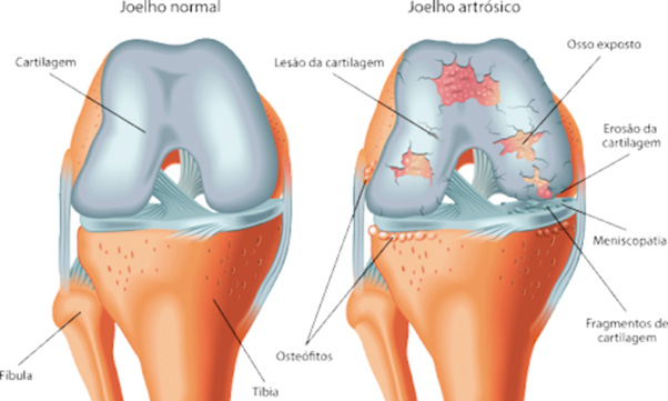 Osteoartrite e osteoartrose 