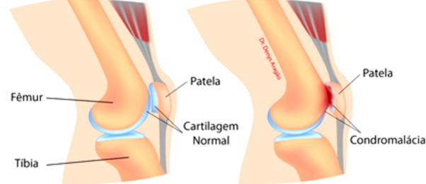 Condromalácia patelar